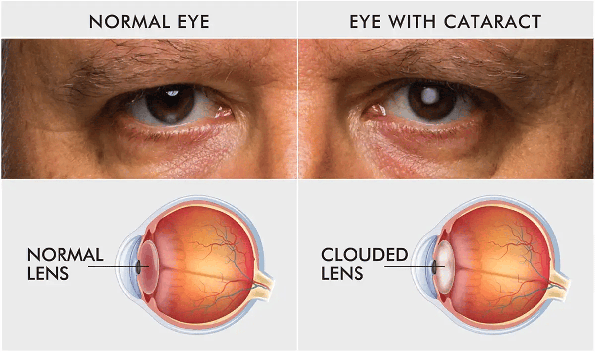 Normal Eye vs Cataract Eye